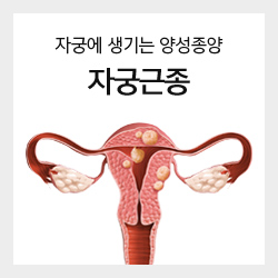 자궁에 생기는 양성종양 자궁근종